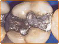 Amalgam
