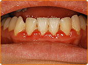 Borstenspitzen Richtung Zahnfleischrand